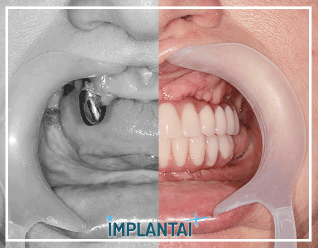 2-abieju-zandikauliu-all-on-4-implantacija