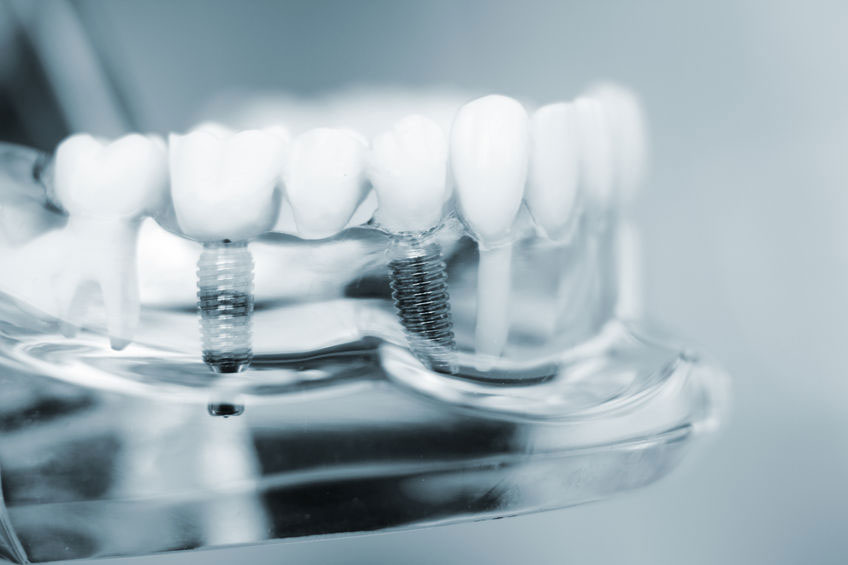 danties implantacija issimoketinai