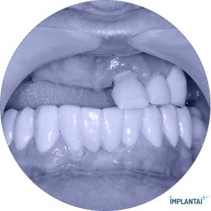 atvejis Dental Implantai Implantaiplius