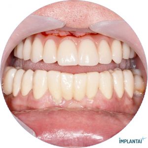 atvejis Dental Implantai Implantaiplius