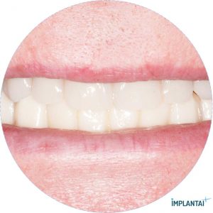 atvejis Dental Implantai Implantaiplius