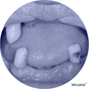 atvejis Dental Implantai Implantaiplius