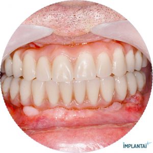 atvejis Dental Implantai Implantaiplius