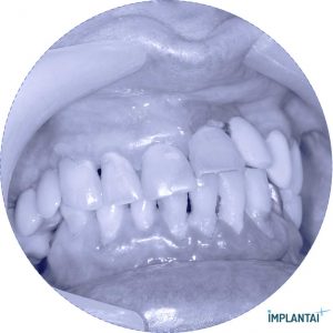atvejis Dental Implantai Implantaiplius