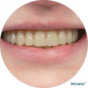atvejis Dental Implantai Implantaiplius