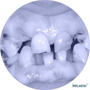 atvejis Dental Implantai Implantaiplius