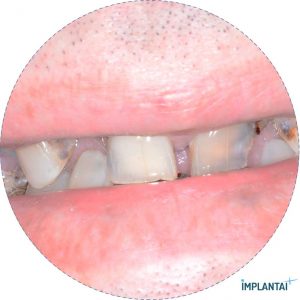 atvejis Dental Implantai Implantaiplius