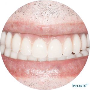 atvejis Dental Implantai Implantaiplius