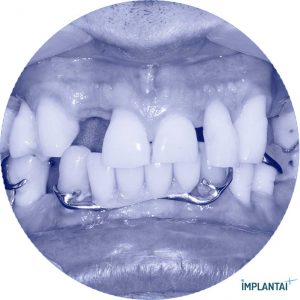 atvejis Dental Implantai Implantaiplius