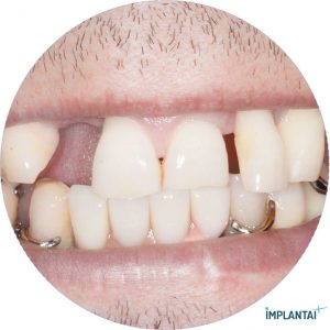 atvejis Dental Implantai Implantaiplius