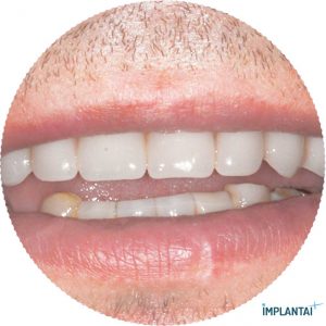 atvejis Dental Implantai Implantaiplius