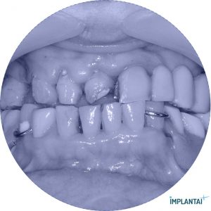 atvejis Dental Implantai Implantaiplius