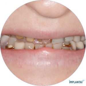 atvejis Dental Implantai Implantaiplius
