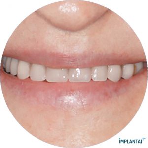 atvejis Dental Implantai Implantaiplius