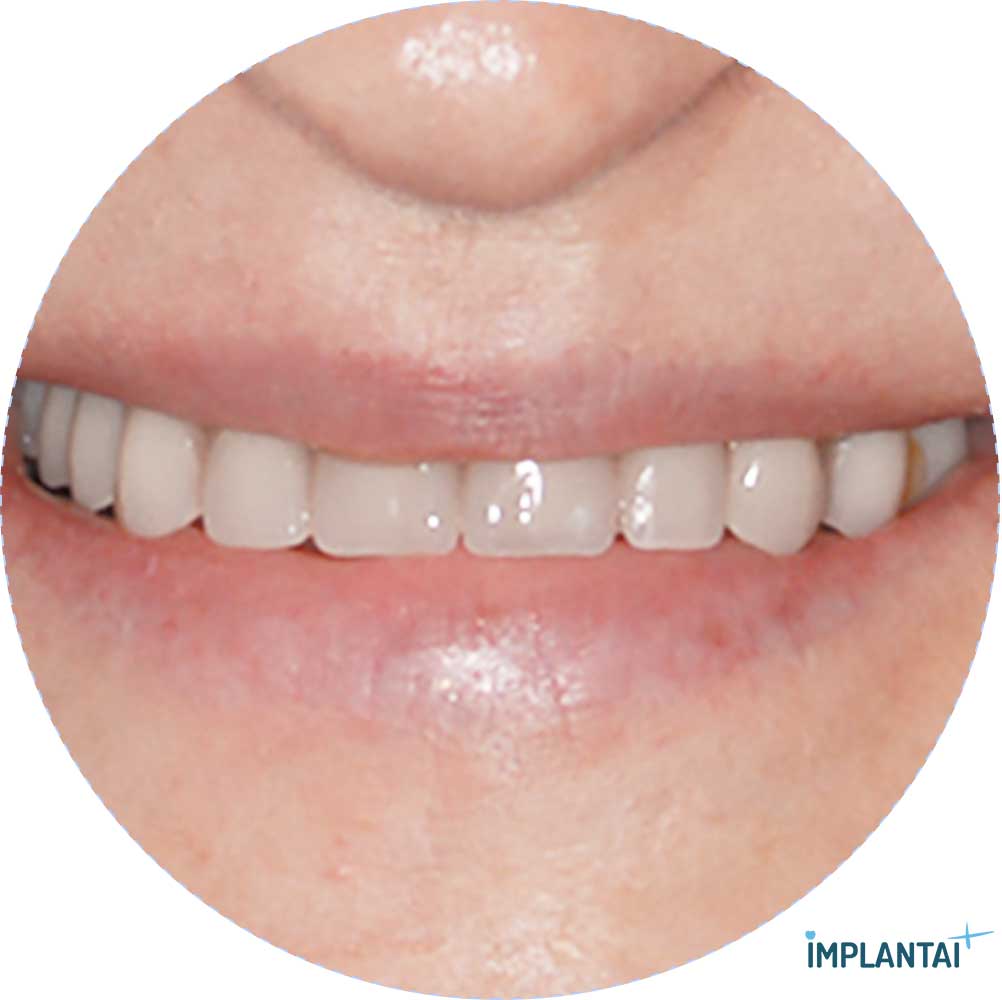 atvejis Dental Implantai Implantaiplius