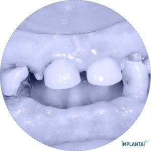 atvejis Dental Implantai Implantaiplius