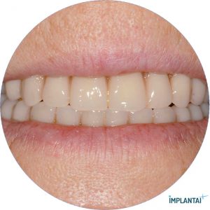 atvejis Dental Implantai Implantaiplius