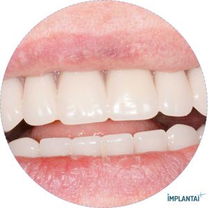 atvejis Dental Implantai Implantaiplius