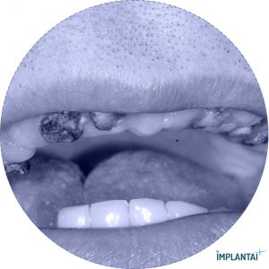 atvejis Dental Implantai Implantaiplius