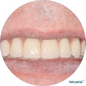 atvejis Dental Implantai Implantaiplius