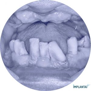 atvejis Dental Implantai Implantaiplius