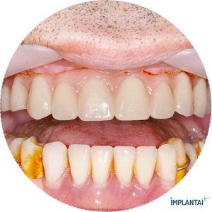 atvejis Dental Implantai Implantaiplius