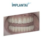 Danties implantacija