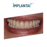 Dantų implantacija Vilniuje
