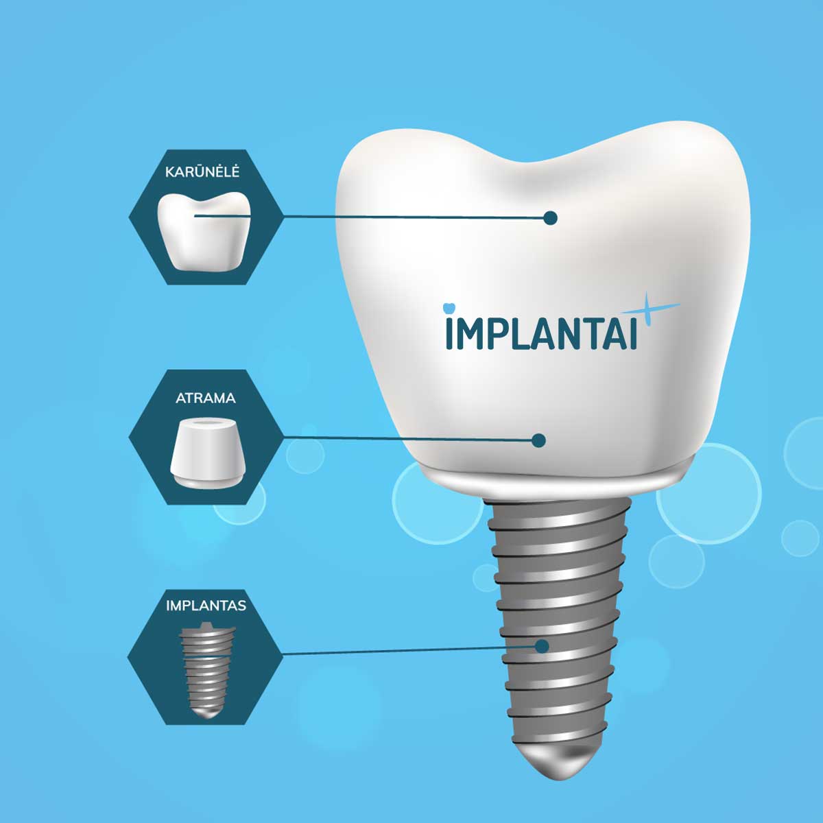 Dantų implantai