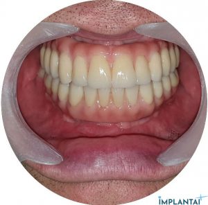 atvejis Dental Implantai Implantaiplius