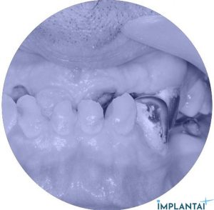 atvejis Dental Implantai Implantaiplius