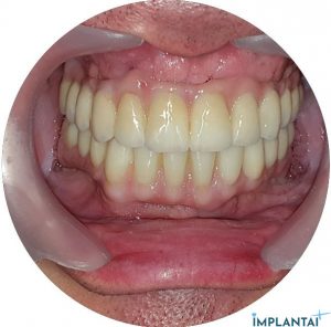 Visi dantys ant 4 implantų protezavimo atvejis