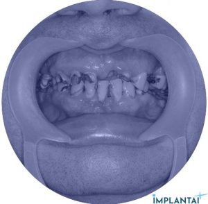 atvejis Dental Implantai Implantaiplius