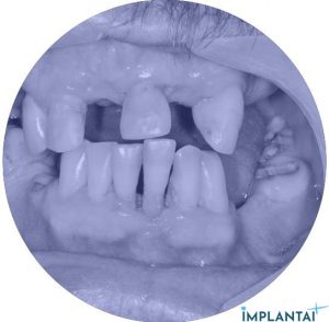 atvejis Dental Implantai Implantaiplius