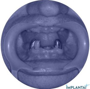 atvejis Dental Implantai Implantaiplius