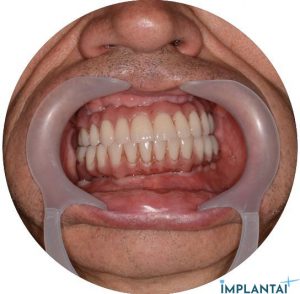 atvejis Dental Implantai Implantaiplius