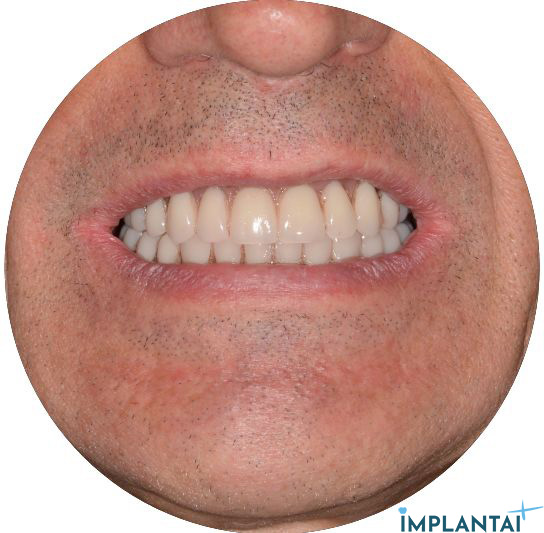atvejis Dental Implantai Implantaiplius