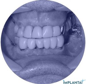 atvejis Dental Implantai Implantaiplius