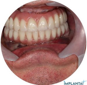 atvejis Dental Implantai Implantaiplius