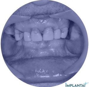atvejis Dental Implantai Implantaiplius