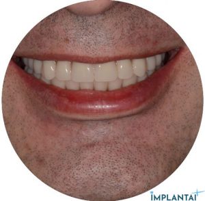 atvejis Dental Implantai Implantaiplius