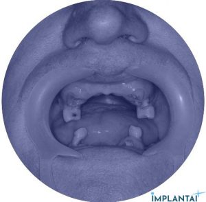 atvejis Dental Implantai Implantaiplius