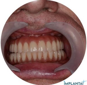 atvejis Dental Implantai Implantaiplius