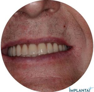 atvejis Dental Implantai Implantaiplius