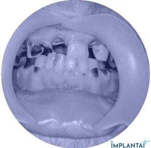 atvejis Dental Implantai Implantaiplius