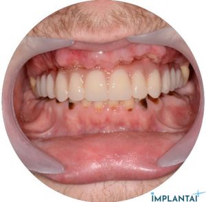 atvejis Dental Implantai Implantaiplius