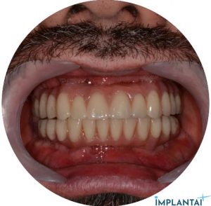 atvejis Dental Implantai Implantaiplius