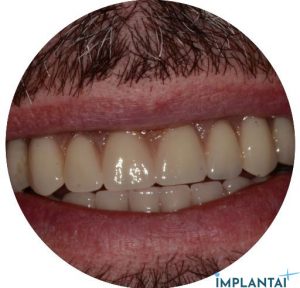 atvejis Dental Implantai Implantaiplius