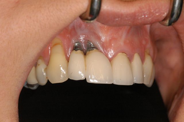 dantu-implantu-atmetimas