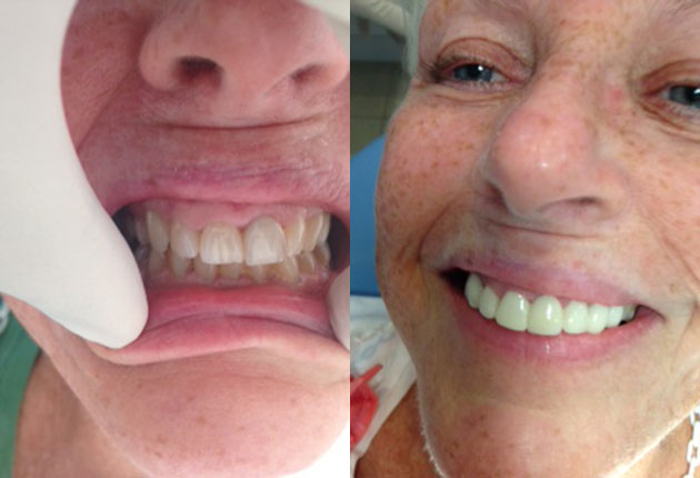 dental implants